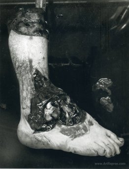 Untitled (Amputated Foot)