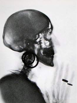 X-Ray of M.O.'s Skull